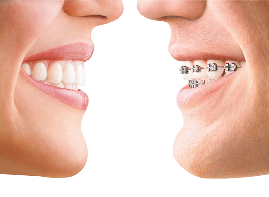 Invisalign madrid