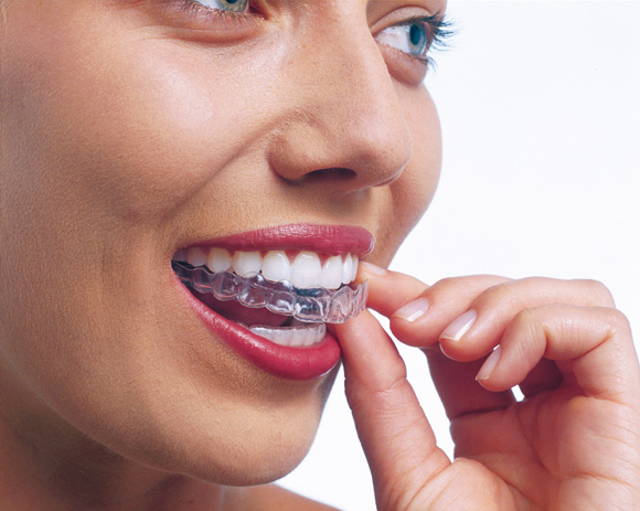 Invisalign madrid