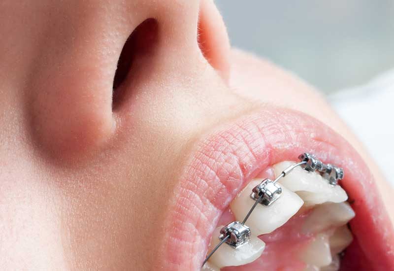 Brackets Metálicos - Clínica Dental Micale