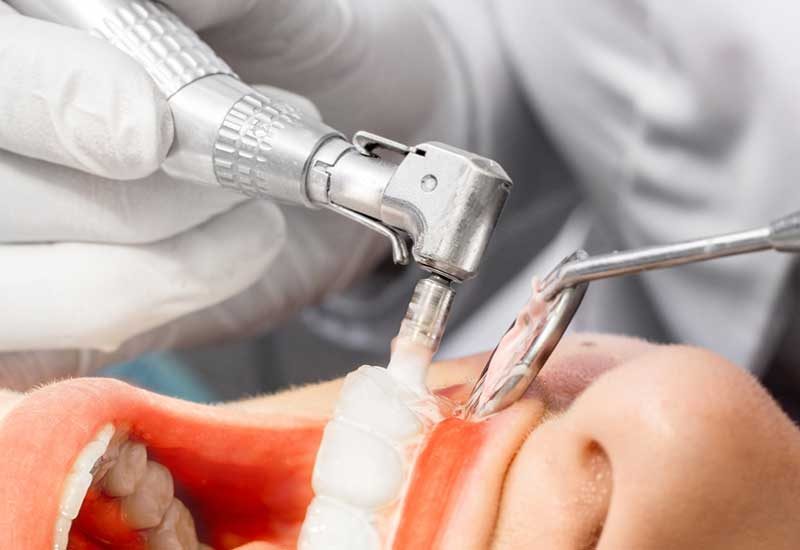 Profilaxis o Limpieza Dental Profesional - Clínica Dental Micale