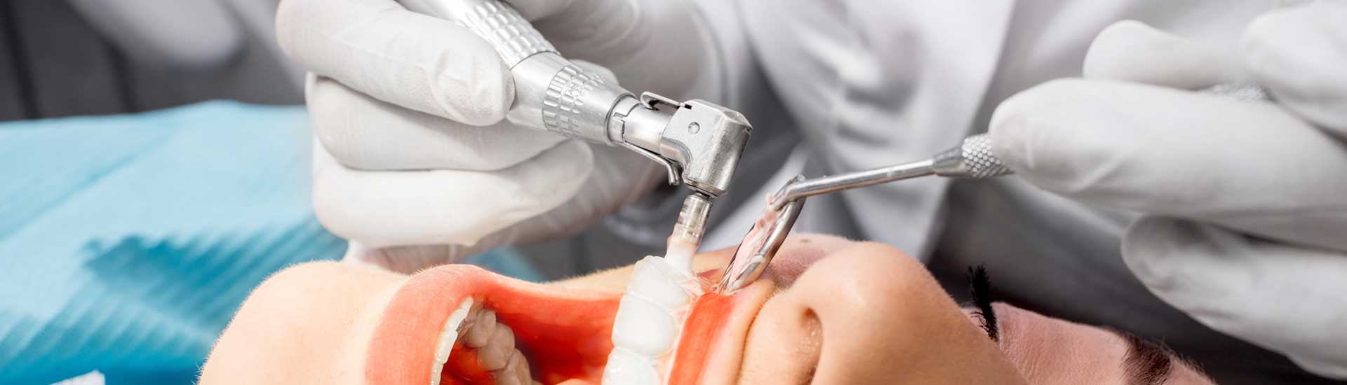 Profilaxis o Limpieza Dental Profesional - Clínica Dental Micale