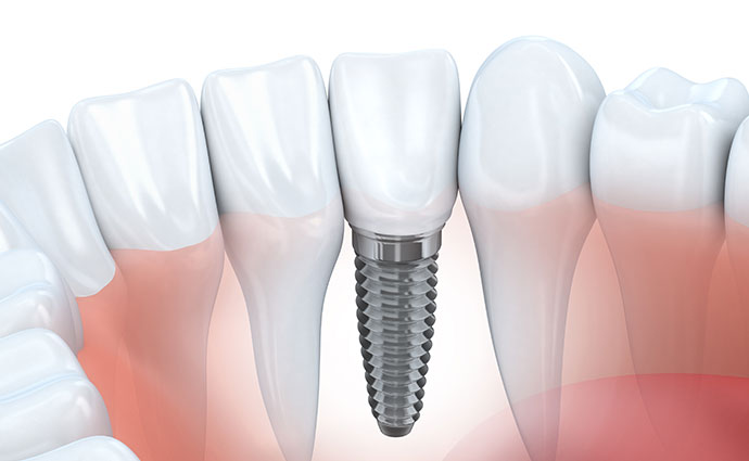 Prótesis dentales - Clínica Micale