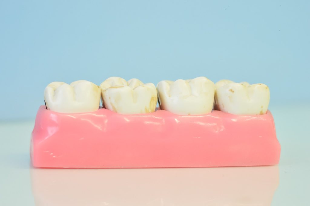Precio de un implante dental en Madrid