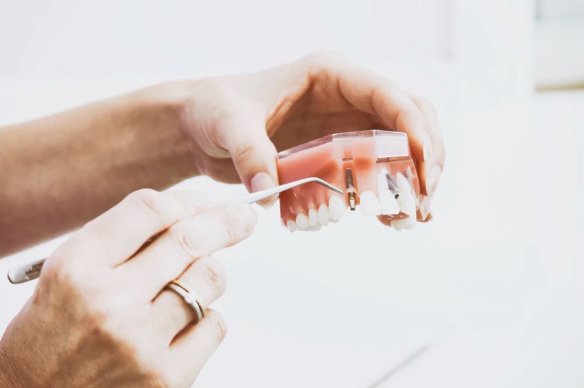 Implantes dentales en Madrid baratos - Micale Dental