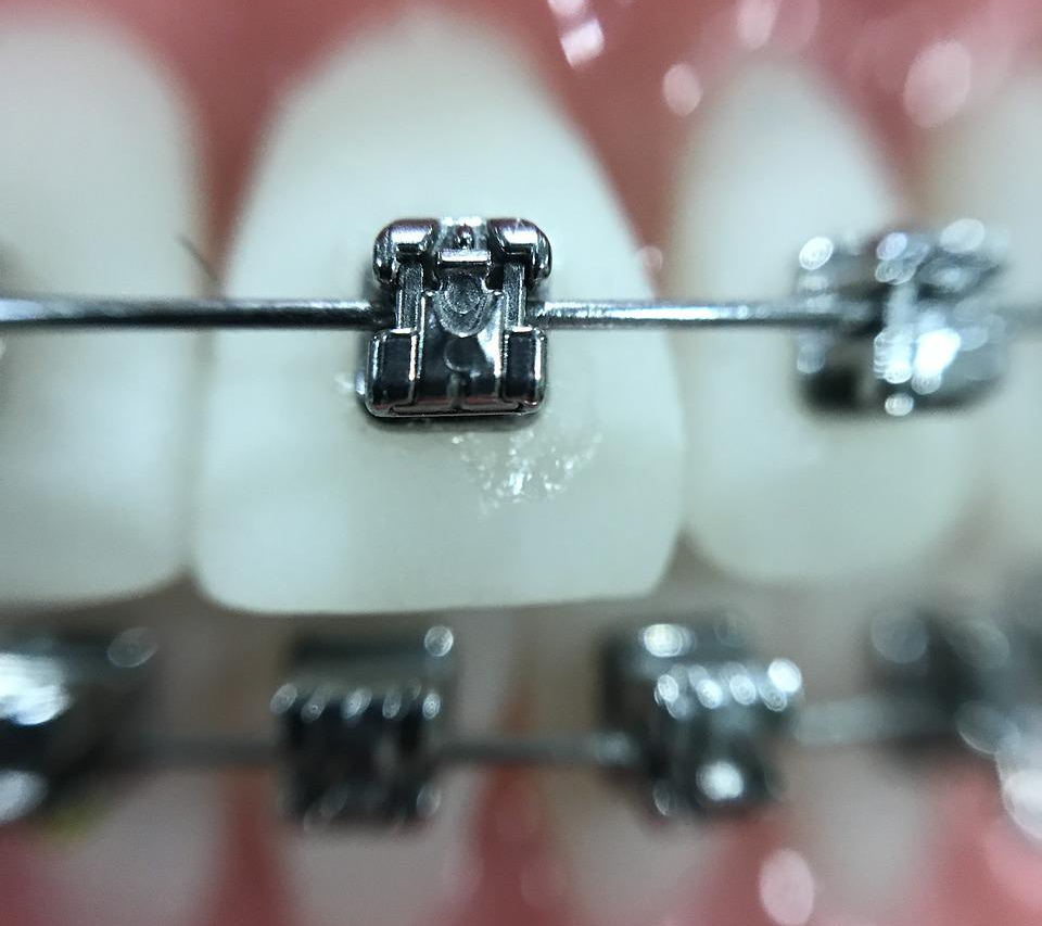 ¿Puedo ponerme ortodoncia si tengo implantes?