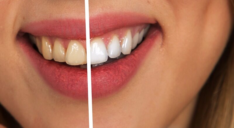 ¿Cuánto cuesta un blanqueamiento dental en Madrid?