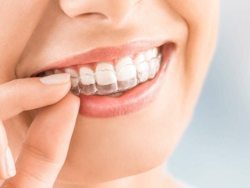 ¿En cuánto tiempo se ven resultados con Invisalign?