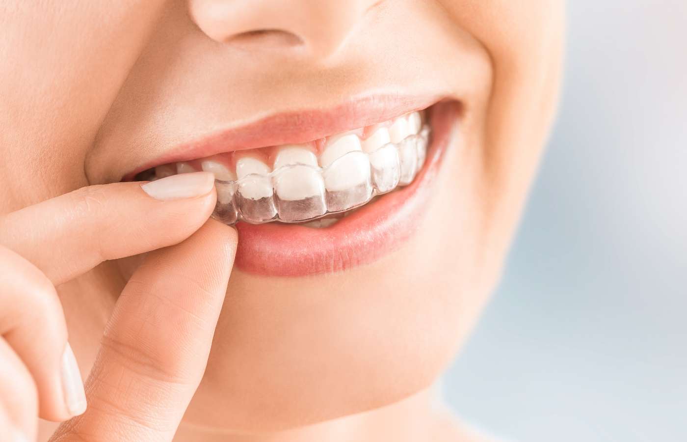 ¿En cuánto tiempo se ven resultados con Invisalign?