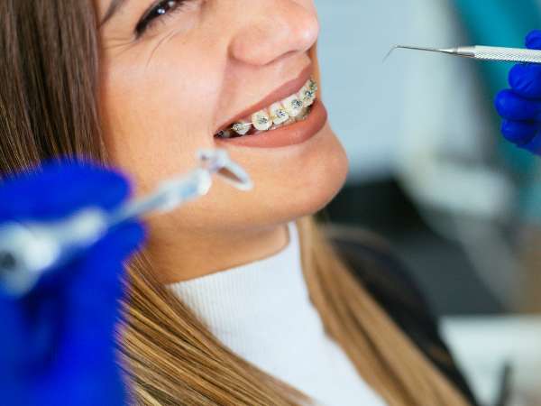 ¿Cuánto tardan en poner los brackets los dentistas?