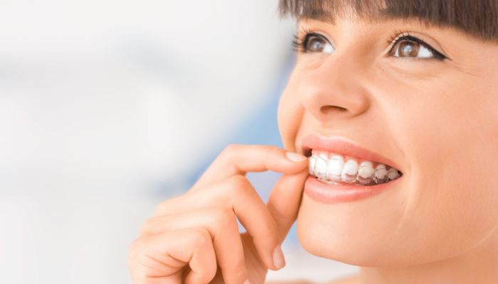 ¿Para qué sirven los ataches de Invisalign?