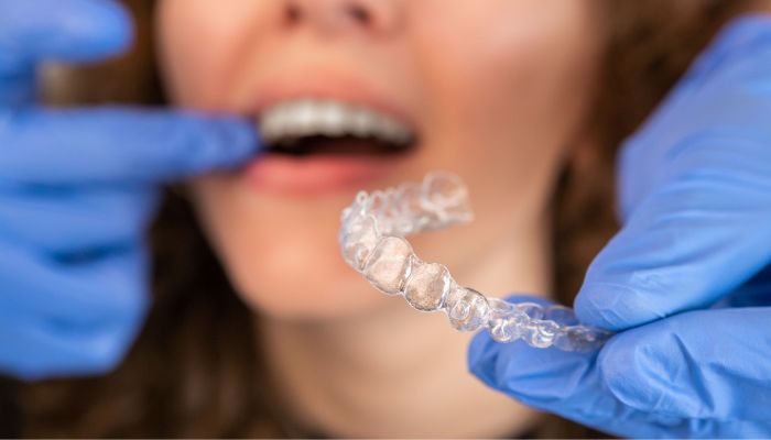 Tipos de Invisalign